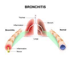 Akute Bronchitis Ursachen Symptome Krank De