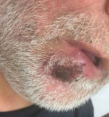Image result for syphilis ulcer