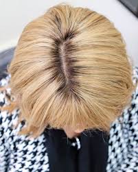 Lichen planopilaris causes smooth, shiny patches of scalp hair loss. Caroline S Story Of Lichen Planopilaris Lucinda Ellery Hair Loss Consultancy