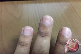Leukonychia adalah suatu kondisi di mana muncul garis, titik, atau salah satu penyebab munculnya tanda putih di kuku adalah kekurangan asupan zinc dalam tubuh. Arti Tanda Putih Di Kuku Antara News