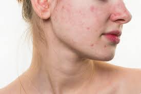 Image result for acne face