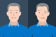 Image result for bell's palsy