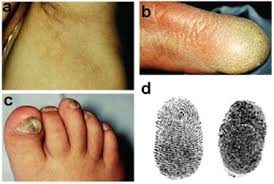Gilles de la tourette syndrome. Naegeli Franceschetti Jadassohn Syndrome And Dermatopathia Pigmentosa Reticularis Two Allelic Ectodermal Dysplasias Caused By Dominant Mutations In Krt14 Sciencedirect