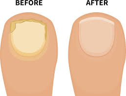 Some people, therefore, claim that it may be effective as a treatment for nail fungus. How To Use Tea Tree Oil For Nail Fungus Treatment 14 Expert Ways