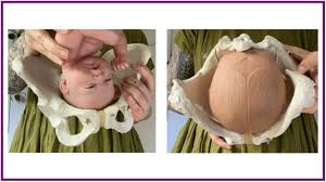 Image result for Manual Rotation in Occipitoposterior Presentation