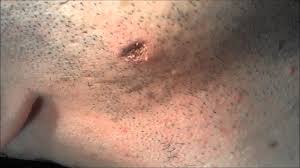 Sometimes you get strange type of bumps on your face, arms or legs and you think they are pimples…or an allergy to something, but they are not rashes or pimples; Ingrown Hair Removal Gone Wrong Dermatologist Blows Hole In Face Youtube
