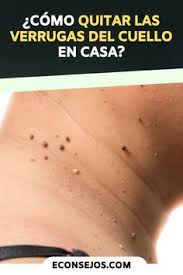 8 Formas naturales para quitar las verrugas del cuello