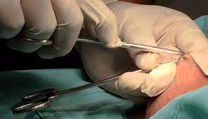 La vasectomia sin bisturí ni agujas (vsbsa) es la técnica más segura, con menos complicaciones y con una más rápida recuperación que existe en la actualidad. Vasectomia Sin Visturi