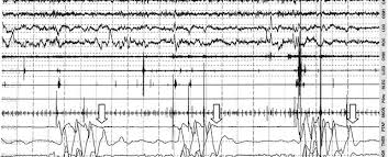 Image result for Polysomnogram