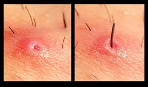 Ingrown hairs can produce inflammation of hair follicles. Popping Infected Hair Follicle Closeup Infectedfollicle Infectedhairfollicle Ingrownhairthigh Ingrown Hair Ingrown Hair Remedies Ingrown Hair Removal