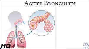 Image result for Acute Bronchitis