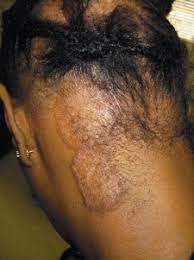 Sarcoidosis is a condition that develops when cells in your immune system form lumps, called granulomas, in organs in the body. Sarcoidosis Are There Differences In Your Skin Of Color Patients Sciencedirect