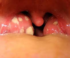 Below are 15 ways on how to get rid of tonsil since these stones can cause multiple oral infections due to the bacteria lodged on the crypts, knowing how to. Tonsillectomy Surgery In Adults Children Reasons To Remove Benefits Recovery Time Ent Specialists Ents