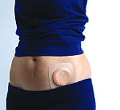 Pin On Ostomy