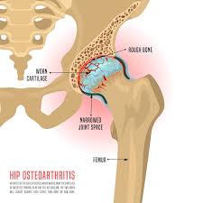 The superficial muscles in the gluteal region consist of the three glutei and the tensor fascia lata. Why Does My Hip Hurt When I Walk Bone Joint