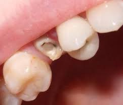Pin On Dental Crowns