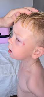 What to do for swollen eyes due to salt water reaction in Gulf Shores?