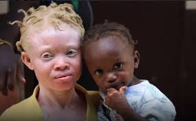 Penyakit Albino Penyebab Gejala Dan Penanganan