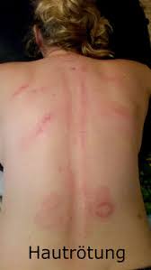 Diese technik wird eingesetzt, um meridiane, muskeln, den rücken, die beine oder arme zu behandeln. Wirkung Von Gua Sha Chiropraktik Heilpraxiss Webseite