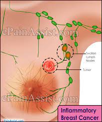 Breastfeeding,* n (%) 34 (85). Inflammatory Breast Cancer Causes Symptoms Treatment Prevention