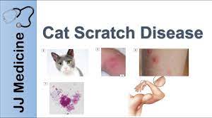 A person should contact their doctor immediately if they experience the following symptoms Cat Scratch Disease Causes Symptoms And Treatment Youtube