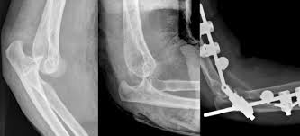 Image result for Elbow Dislocation