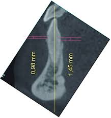 80 видов кофе и чая. Cbct For Estimation Of The Cemento Enamel Junction And Crestal Bone Of Anterior Teeth