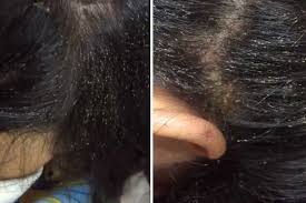 Repeating the nix (permethrin) shampoo in 1 week helps. Hundreds Of Head Lice Crawl On Girl S Scalp In Hair Raising Video Health News Asiaone