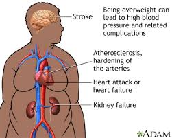 health risks of obesity medlineplus medical encyclopedia