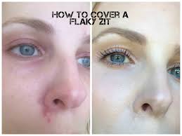 how to cover up a flaky pimple