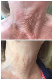 Maybe you would like to learn more about one of these? Botox