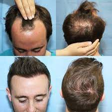 Before And After 3200 Hair Grafts Were Used To Completely Transform This Hair Line Hair Hairloss Hairrestora Hair Clinic Hair Grafting Hair Restoration
