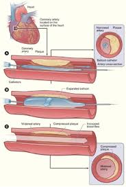 Angioplasty is a procedure to restore blood flow through narrow or blocked arteries. Coronary Angioplasty And Stenting Cardiac Surgery Michigan Medicine University Of Michigan