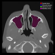 Image result for Maxillary Sinus