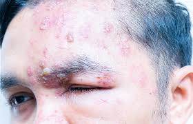 Shingles Treatment In Nyc Herpes Zoster Shingles Rash