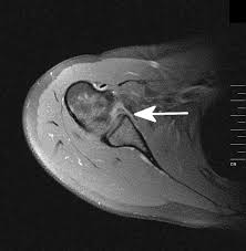 Einen termin zur erklärung beim doc. Datei Bankart Lasion Jpg Wikibooks Sammlung Freier Lehr Sach Und Fachbucher