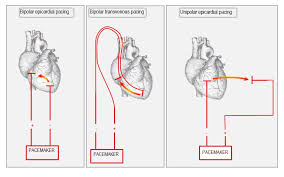 Several types of bipolar lead exist: Anatomy Of The Temporary Pacemaker Circuit Deranged Physiology
