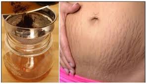 Bu Karisim Sayesinde Karin Catlaklarindan Kurtulun Saglik Paylasimlari Deri Catlaklari Hamilelik Catlak Giderme