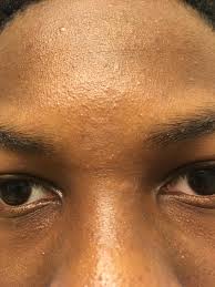 Closed comedones are pimples on the surface of the skin that are hidden by a blocked pore. Acne Should I Use An Aha Or Bha For Closed Comedones And Sebaceous Filaments Sebaceous Filaments Skin Concern Skin