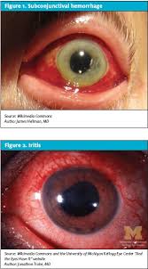 Image result for Ciliary Flush