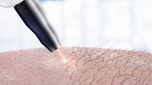 Check spelling or type a new query. Laser Hair Removal Series How To Prepare Hillandale Primary Care