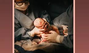 Image result for External Cephalic Version