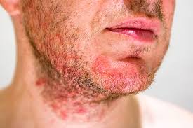 Çoğu zaman yaşam kalitesini etkileyebilecek kadar çok kaşıntıya neden olan seboreik dermatit nedir, nasıl oluşur ve tedavi edilir? Seboreik Dermatit Prof Dr Mustafa Ozdemir