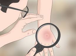 What do brown recluse bites look like in the beginning? How To Identify A Brown Recluse 11 Steps With Pictures