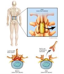 Degenerative Disk Disease Mankato Mayo Clinic Health System