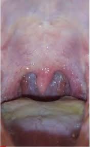 I know exactly that sinking feeling. Bumps In The Back Of My Throat For 6 Months Please Help Askdoctorsmeeee