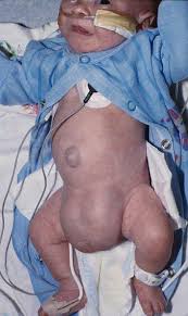 Image result for Inguinal hernia child