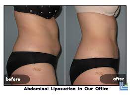 Thus, after 150 pound woman has two liposuction surgeries, where each surgery removes 4 pounds of fat (total of 8 pounds, equal one gallon), she should ideally keep her weight at or below 142 pounds. Medical Weight Loss With Liposuction In St Louis St Louis Laser Liposuction Center