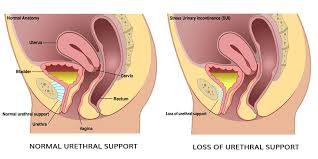 Image result for Pessary