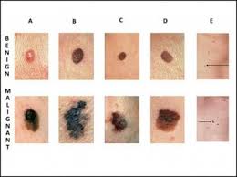 It may be shiny and has fine blood vessels on it. What Is Melanoma Skin Cancer Sero